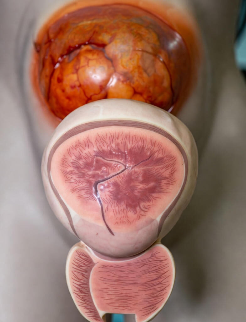 Prostate Cancer:Anatomical model of a human prostate in cross-section, displaying a large dark cancerous tumor in the central zone with surrounding normal prostate tissue
