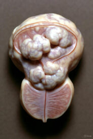 Anatomical model of an enlarged prostate gland with multiple nodular tumors characteristic of advanced prostate cancer.