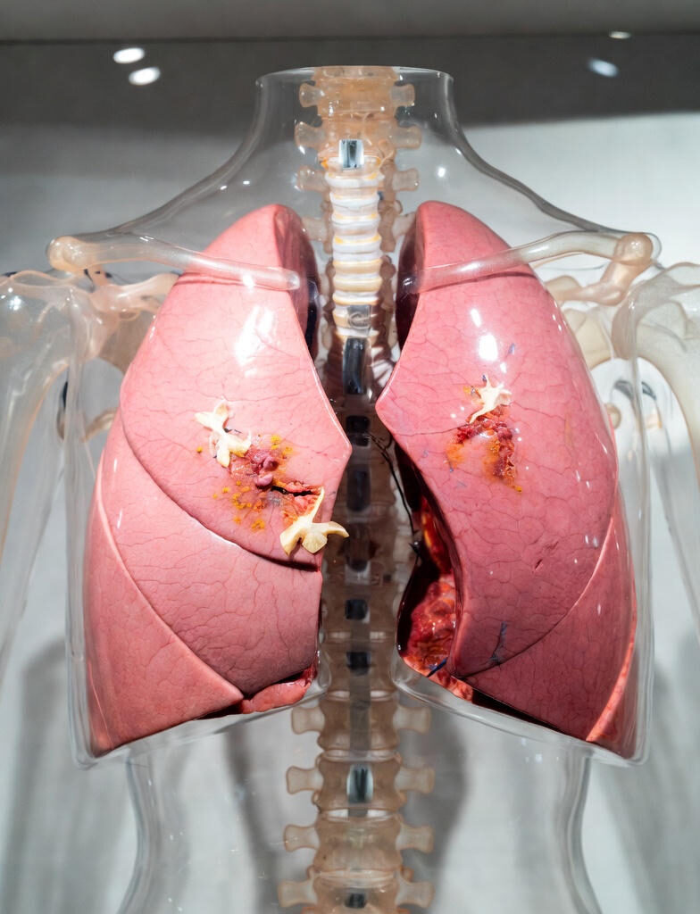 Anatomical model of human lungs affected by advanced lung cancer, showing multiple large tumors, blackened areas, and tissue destruction on both lungs.