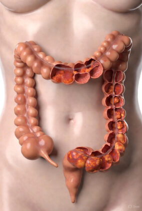 3D illustration of colorectal cancer progression showing multiple adenomatous polyps and cancerous tumors throughout the colon and rectum.