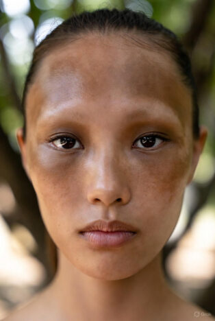 Portrait of a woman of color with melasma, featuring diffuse brown patches primarily on the cheeks, forehead, and chin.